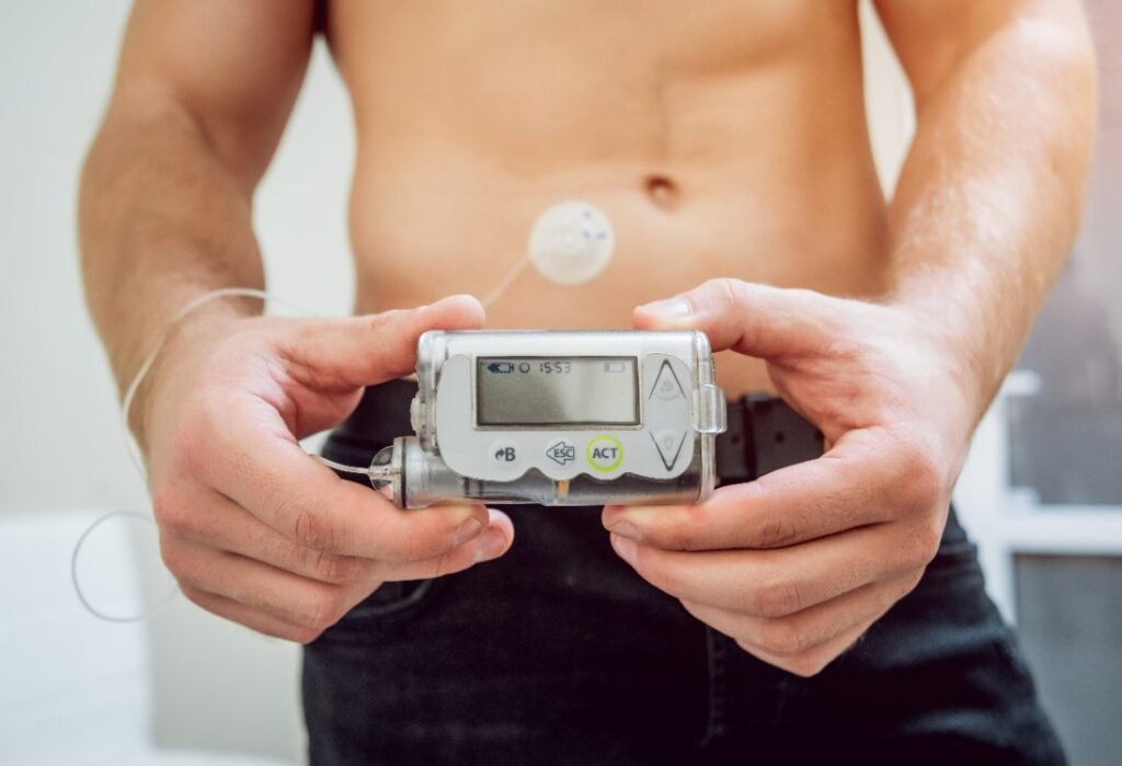 Bomba de insulina com tubo conectada ao abdômen de uma pessoa com diabetes