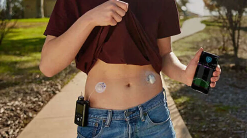 Homem com a bomba de insulina MiniMed 780G no cinto, cateter e sensor no abdômen, olhando o celular
