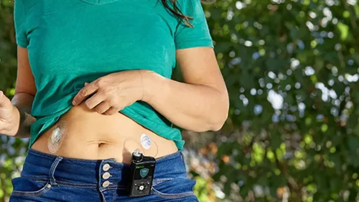 Bomba de insulina MiniMed 780G presa à calça, com o cateter no abdômen