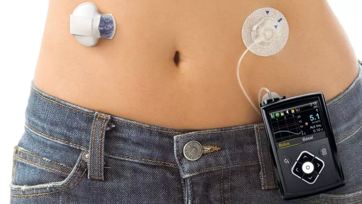 Bomba de insulina MiniMed 780G em uso